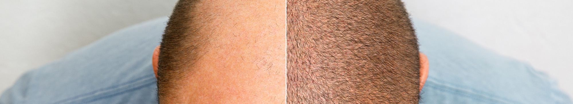 Hair Transplant