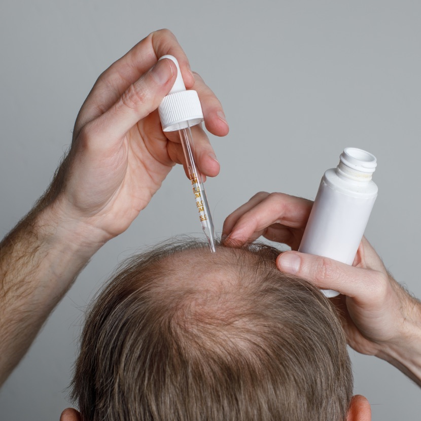 O Minoxidil é eficaz em estágios muito avançados de calvície?